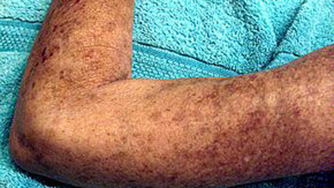 Left_Arm_Scleroderma_Patient