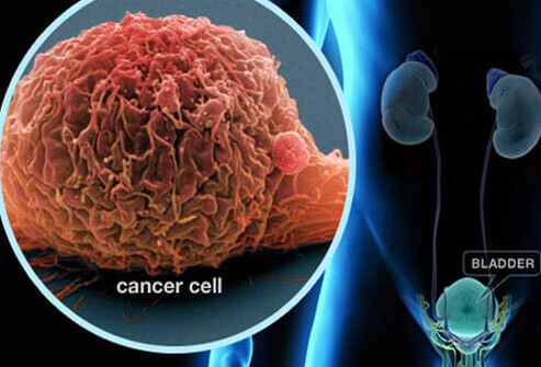 FDA grants Roche's cancer immunotherapy TECENTRIQ ...