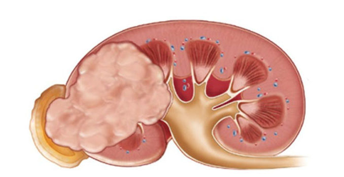 renal-cell-carcinoma-cancer